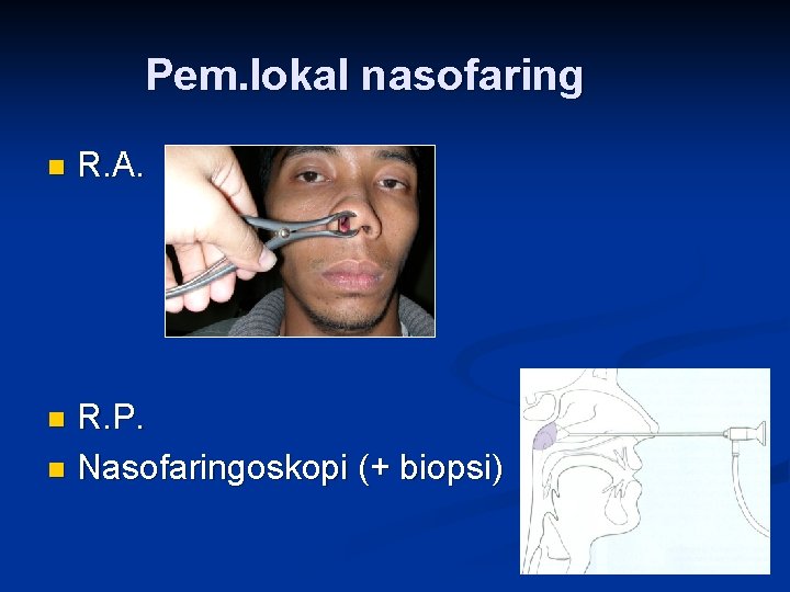 Pem. lokal nasofaring n R. A. R. P. n Nasofaringoskopi (+ biopsi) n 