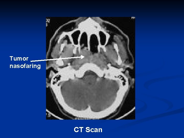 Tumor nasofaring CT Scan 