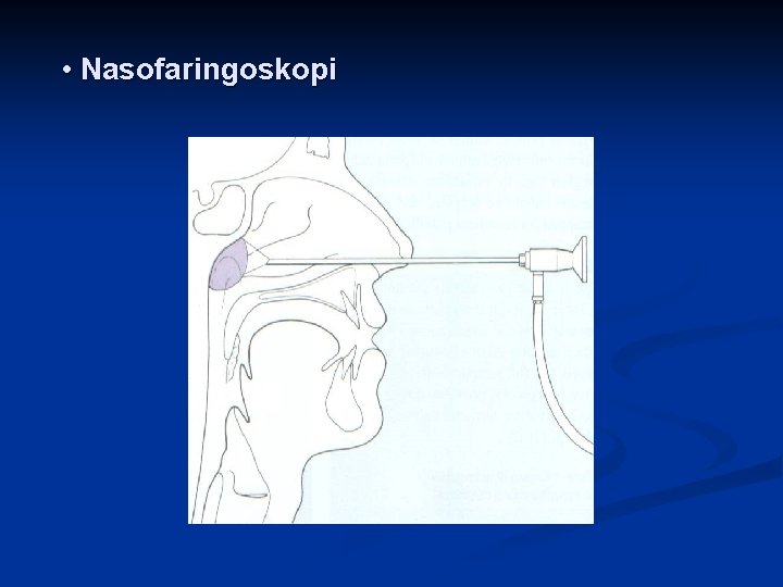  • Nasofaringoskopi 
