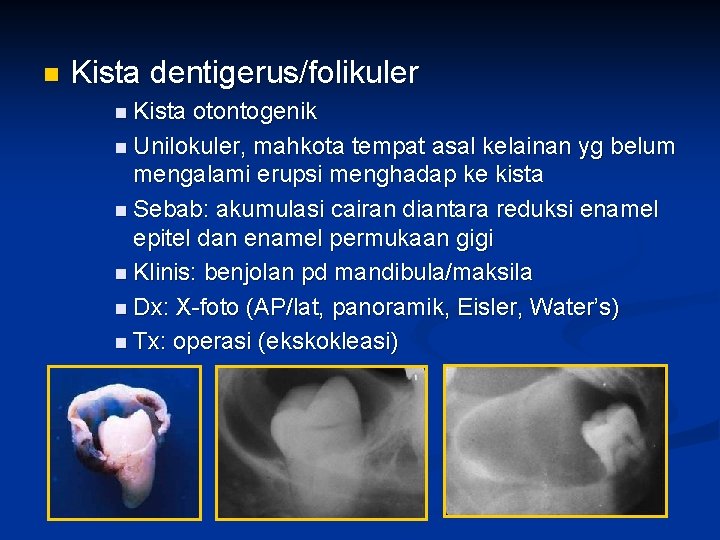 n Kista dentigerus/folikuler n Kista otontogenik n Unilokuler, mahkota tempat asal kelainan yg belum