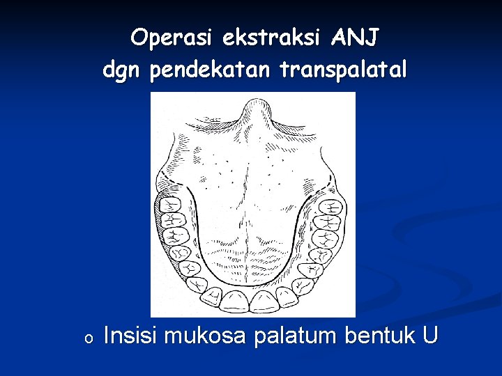 Operasi ekstraksi ANJ dgn pendekatan transpalatal o Insisi mukosa palatum bentuk U 