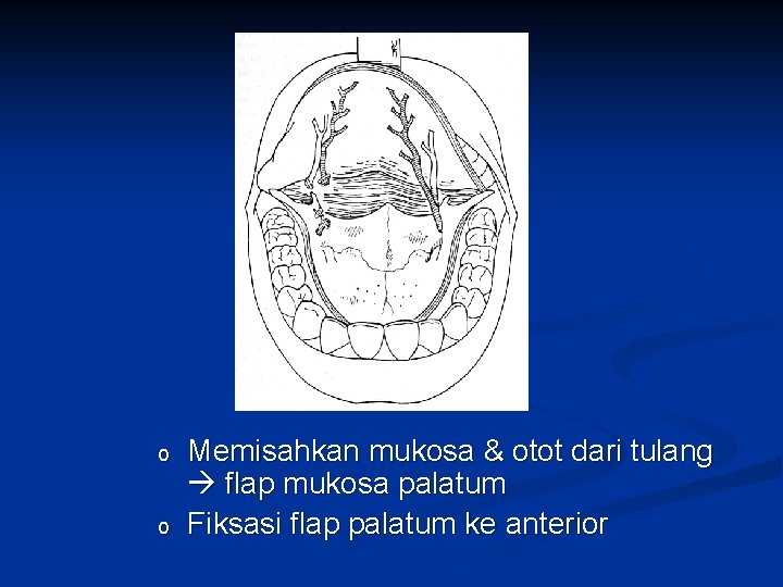 o o Memisahkan mukosa & otot dari tulang flap mukosa palatum Fiksasi flap palatum