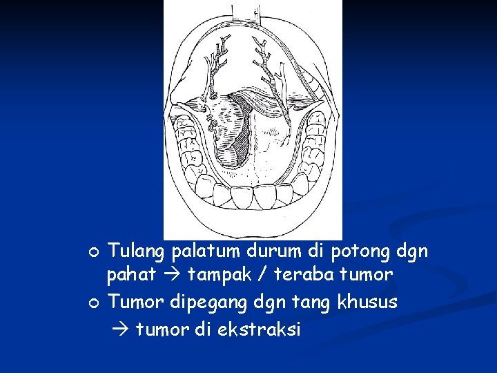 ¢ ¢ Tulang palatum durum di potong dgn pahat tampak / teraba tumor Tumor