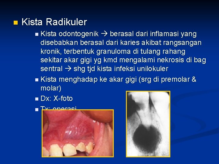 n Kista Radikuler n Kista odontogenik berasal dari inflamasi yang disebabkan berasal dari karies