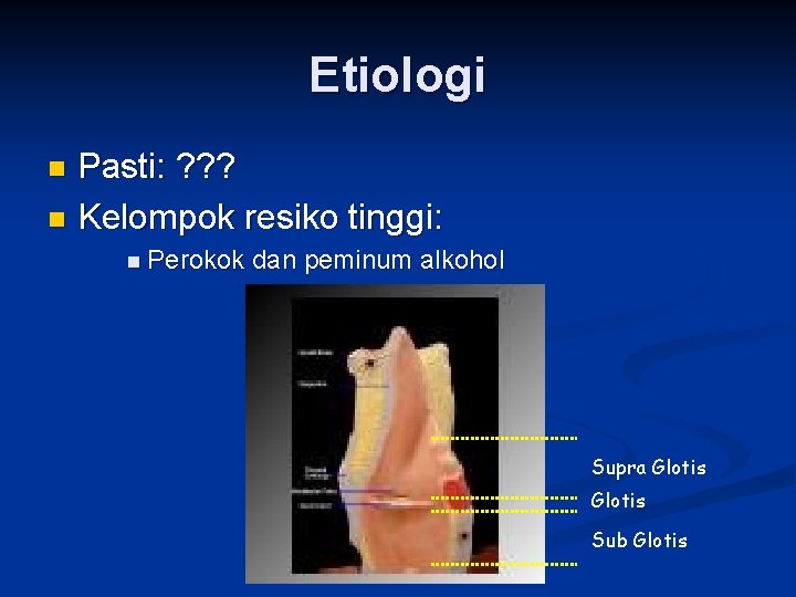 Etiologi Pasti: ? ? ? n Kelompok resiko tinggi: n n Perokok dan peminum