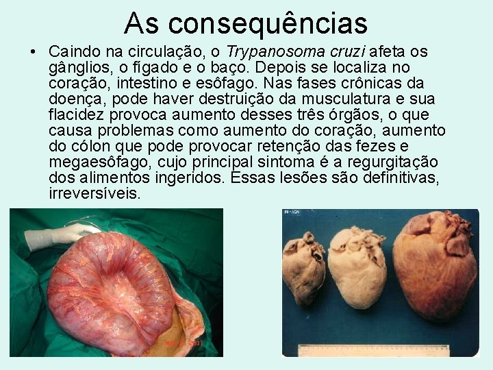 As consequências • Caindo na circulação, o Trypanosoma cruzi afeta os gânglios, o fígado