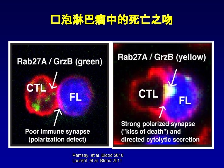 �泡淋巴瘤中的死亡之吻 Ramsay, et al. Blood 2010 Laurent, et al. Blood 2011 