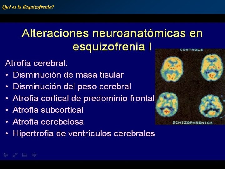 Qué es la Esquizofrenia? 