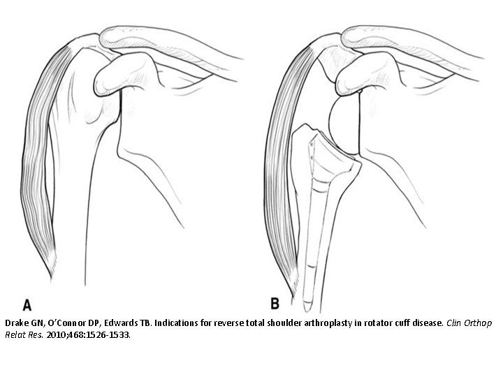 Drake GN, O’Connor DP, Edwards TB. Indications for reverse total shoulder arthroplasty in rotator
