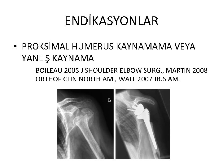 ENDİKASYONLAR • PROKSİMAL HUMERUS KAYNAMAMA VEYA YANLIŞ KAYNAMA BOILEAU 2005 J SHOULDER ELBOW SURG.