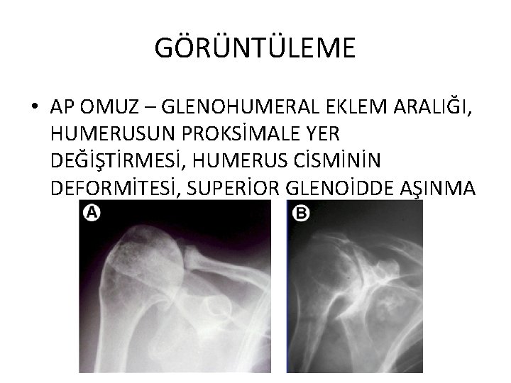 GÖRÜNTÜLEME • AP OMUZ – GLENOHUMERAL EKLEM ARALIĞI, HUMERUSUN PROKSİMALE YER DEĞİŞTİRMESİ, HUMERUS CİSMİNİN