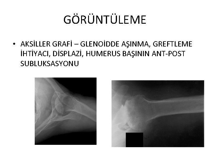 GÖRÜNTÜLEME • AKSİLLER GRAFİ – GLENOİDDE AŞINMA, GREFTLEME İHTİYACI, DİSPLAZİ, HUMERUS BAŞININ ANT-POST SUBLUKSASYONU