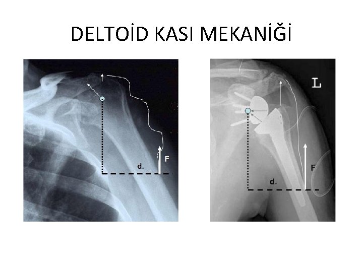 DELTOİD KASI MEKANİĞİ 