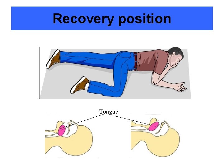 Recovery position Tongue 