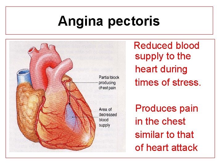 Angina pectoris Reduced blood supply to the heart during times of stress. Produces pain