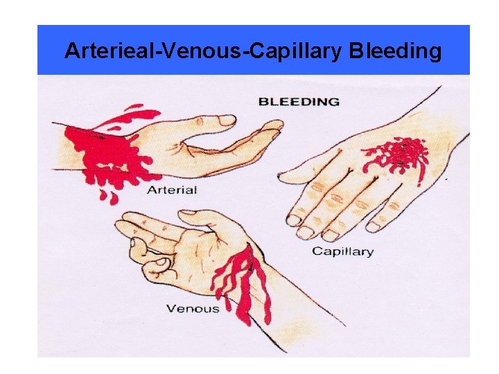 Arterieal-Venous-Capillary Bleeding 