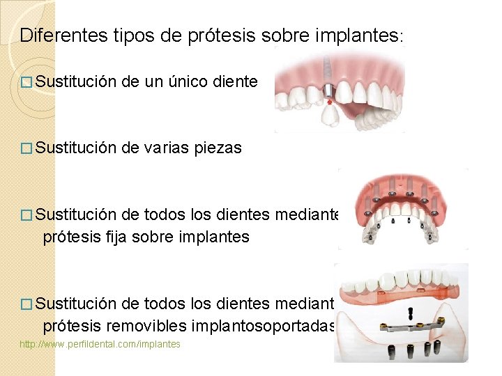  Diferentes tipos de prótesis sobre implantes: � Sustitución de un único diente �