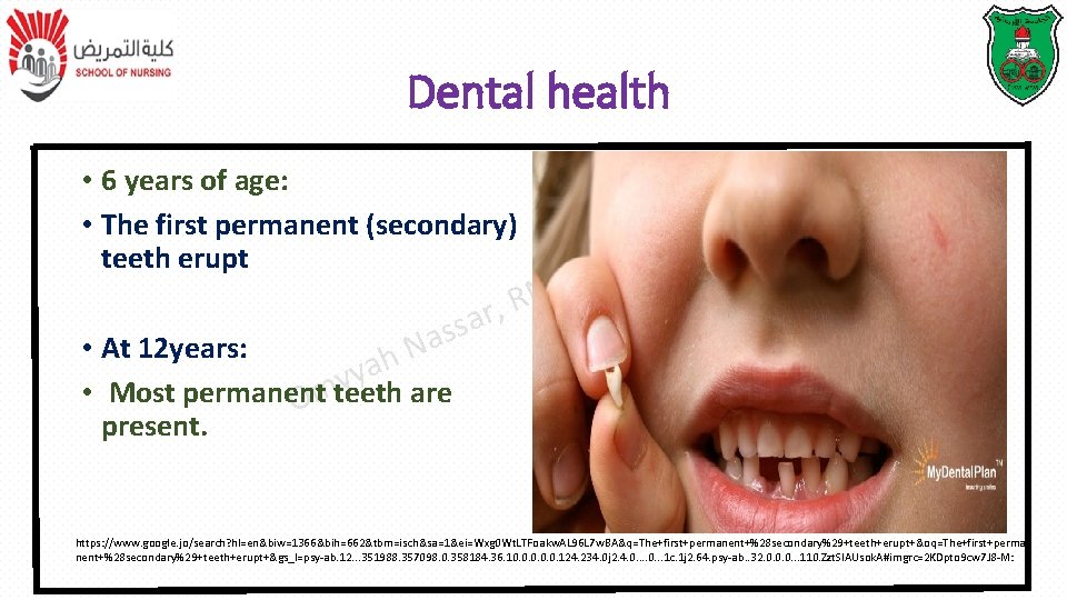 Dental health • 6 years of age: • The first permanent (secondary) teeth erupt