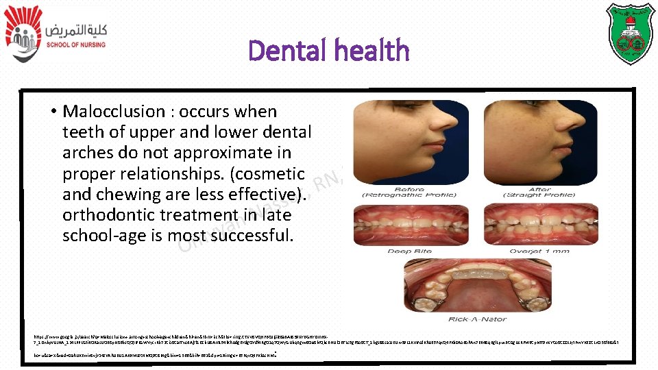 Dental health • Malocclusion : occurs when teeth of upper and lower dental T Dental health • Malocclusion : occurs when teeth of upper and lower dental T