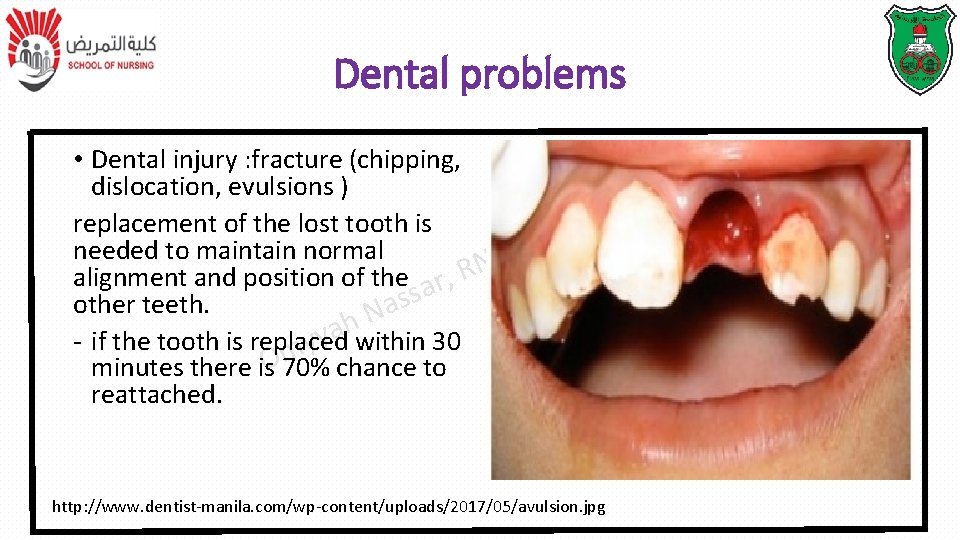 Dental problems • Dental injury : fracture (chipping, dislocation, evulsions ) T P replacement Dental problems • Dental injury : fracture (chipping, dislocation, evulsions ) T P replacement