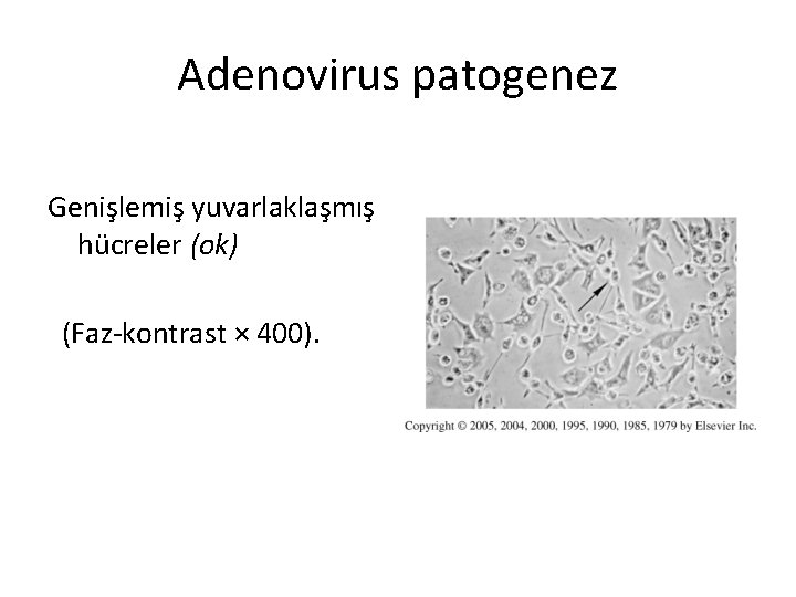 Adenovirus patogenez Genişlemiş yuvarlaklaşmış hücreler (ok) (Faz-kontrast × 400). 