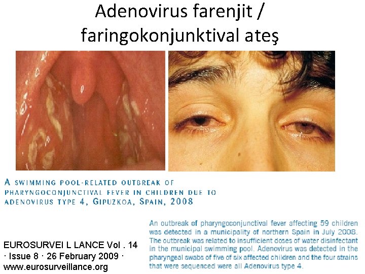 Adenovirus farenjit / faringokonjunktival ateş EUROSURVEI L LANCE Vol. 14 · Issue 8 ·