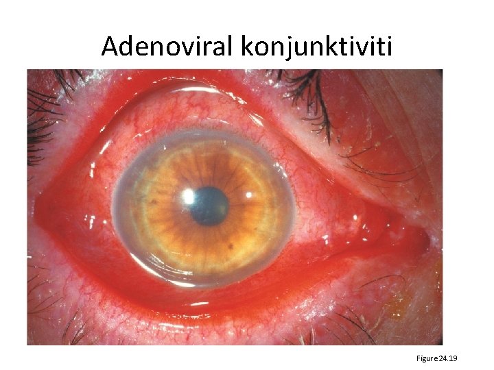 Adenoviral konjunktiviti Figure 24. 19 