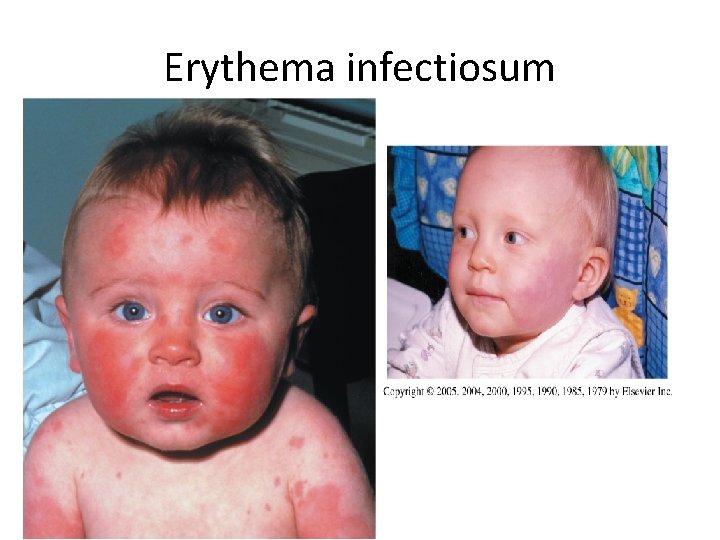 Erythema infectiosum 