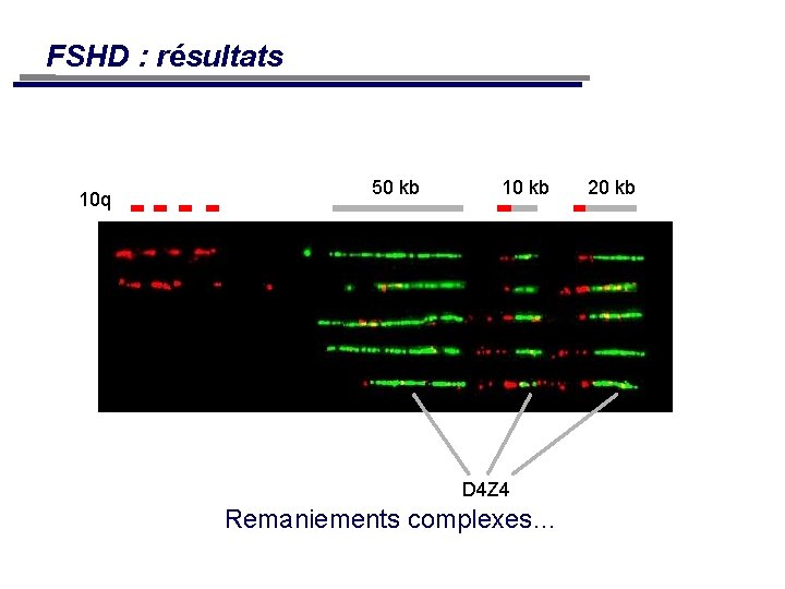 FSHD : résultats 10 q 50 kb 10 kb D 4 Z 4 Remaniements