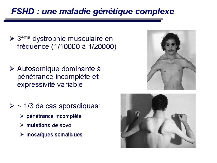 FSHD : une maladie génétique complexe 3ème dystrophie musculaire en fréquence (1/10000 à 1/20000)