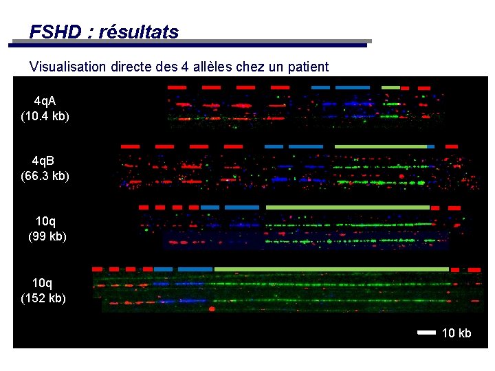 FSHD : résultats Visualisation directe des 4 allèles chez un patient 4 q. A