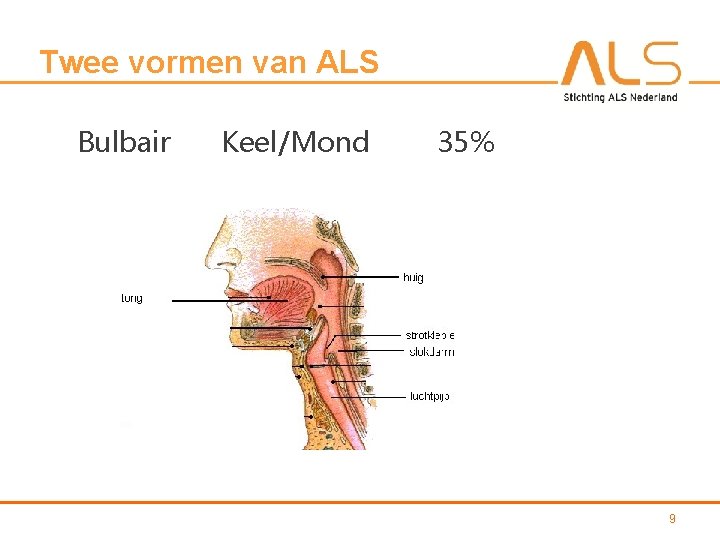 Twee vormen van ALS Bulbair Keel/Mond 35% 9 