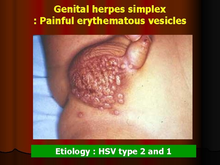 Herpes testi genital Herpes (HSV)