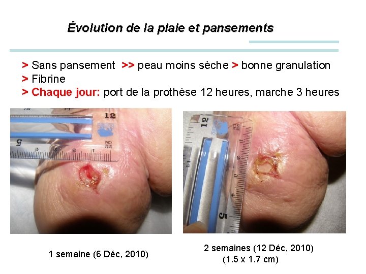 Évolution de la plaie et pansements > Sans pansement >> peau moins sèche >