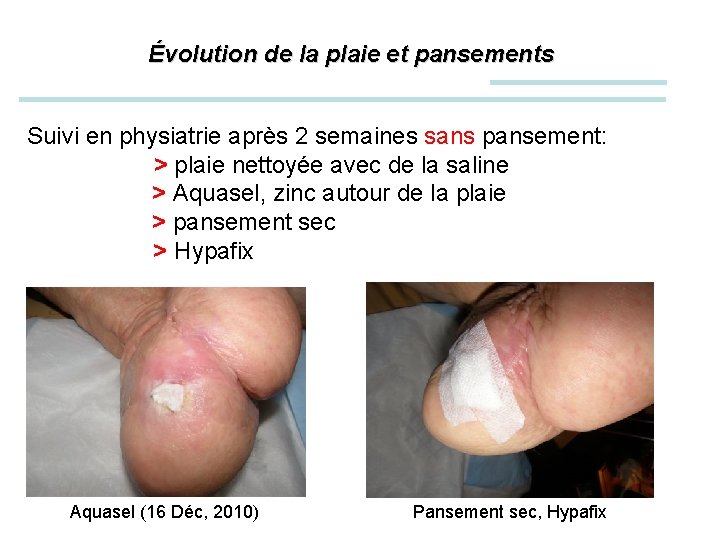 Évolution de la plaie et pansements Suivi en physiatrie après 2 semaines sans pansement: