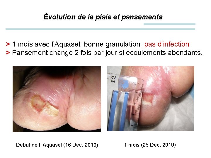 Évolution de la plaie et pansements > 1 mois avec l’Aquasel: bonne granulation, pas