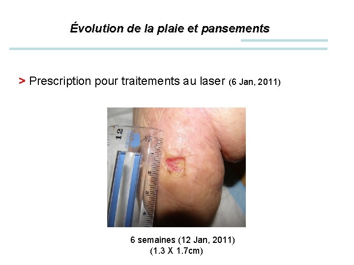Évolution de la plaie et pansements > Prescription pour traitements au laser (6 Jan,