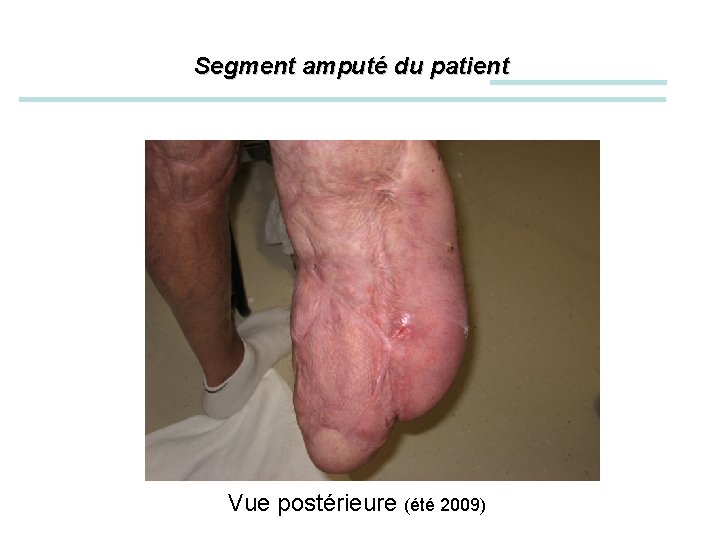 Segment amputé du patient Vue postérieure (été 2009) 
