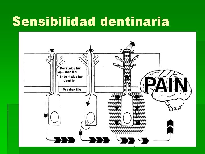 Sensibilidad dentinaria 
