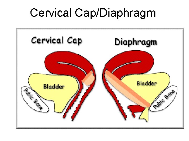 Cervical Cap/Diaphragm 
