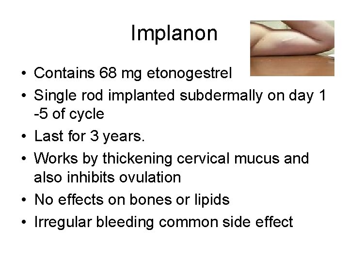 Implanon • Contains 68 mg etonogestrel • Single rod implanted subdermally on day 1