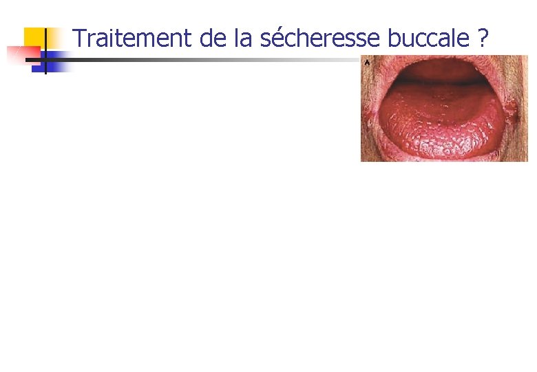 Traitement de la sécheresse buccale ? 