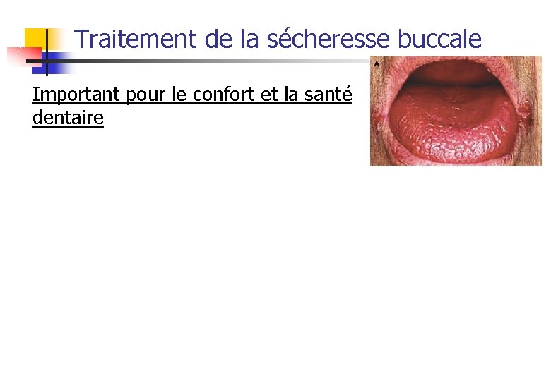 Traitement de la sécheresse buccale Important pour le confort et la santé dentaire 