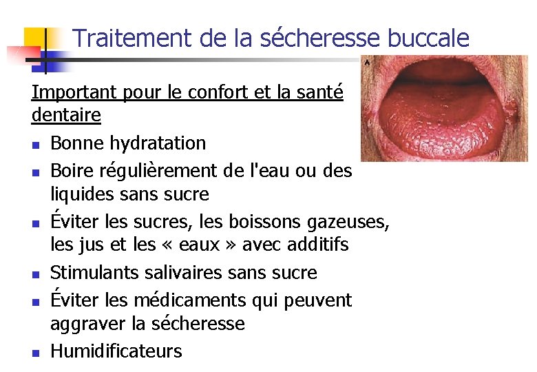 Traitement de la sécheresse buccale Important pour le confort et la santé dentaire n