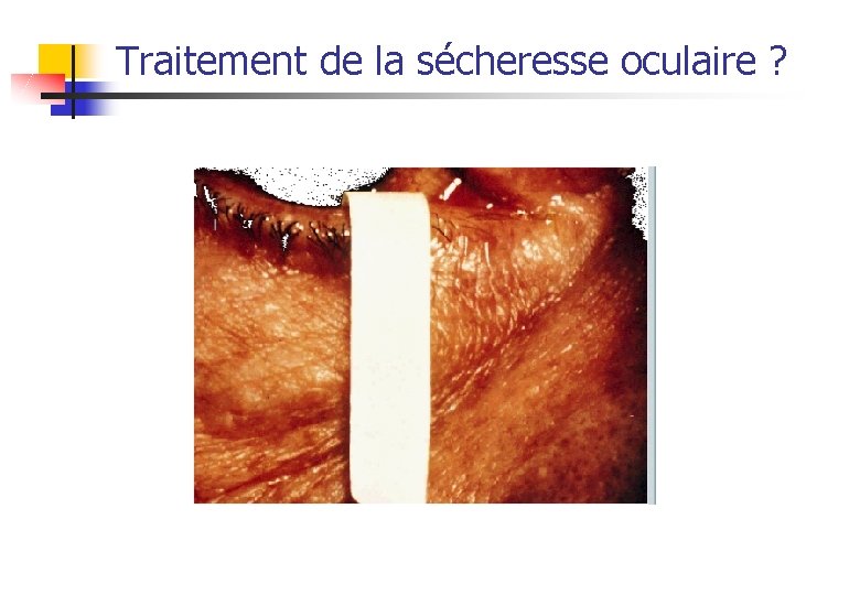 Traitement de la sécheresse oculaire ? 