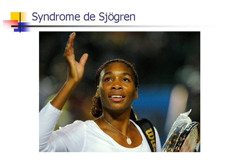 Syndrome de Sjögren 