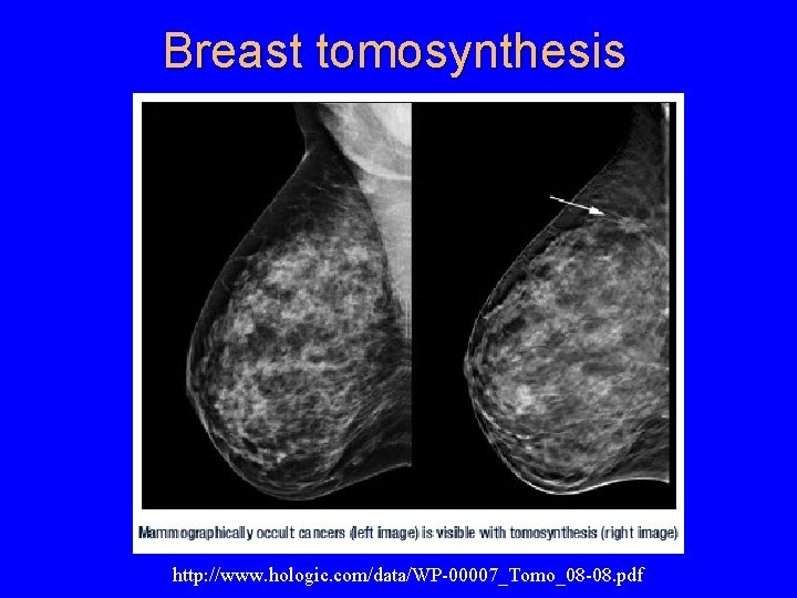 Breast tomosynthesis http: //www. hologic. com/data/WP-00007_Tomo_08 -08. pdf 