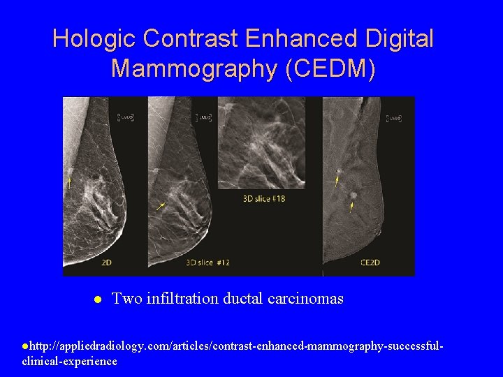 Hologic Contrast Enhanced Digital Mammography (CEDM) Two infiltration ductal carcinomas http: //appliedradiology. com/articles/contrast-enhanced-mammography-successful- clinical-experience