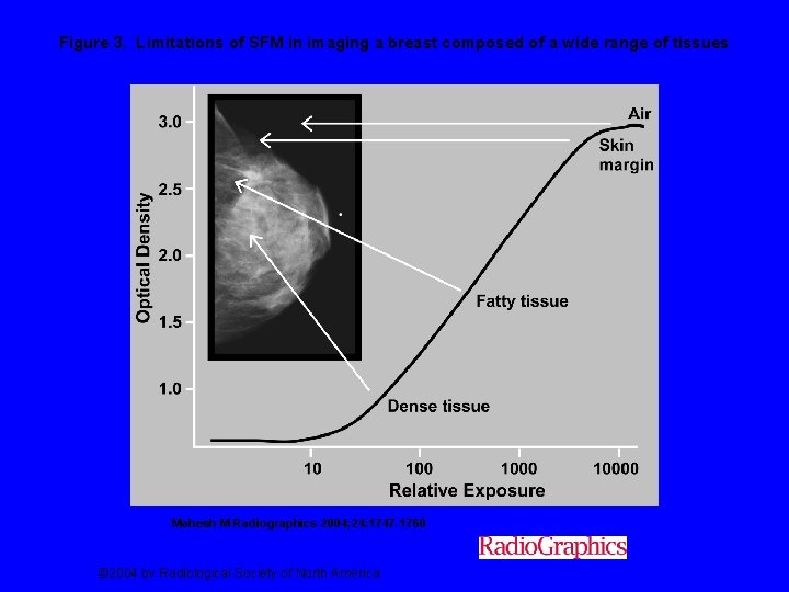 Figure 3. Limitations of SFM in imaging a breast composed of a wide range