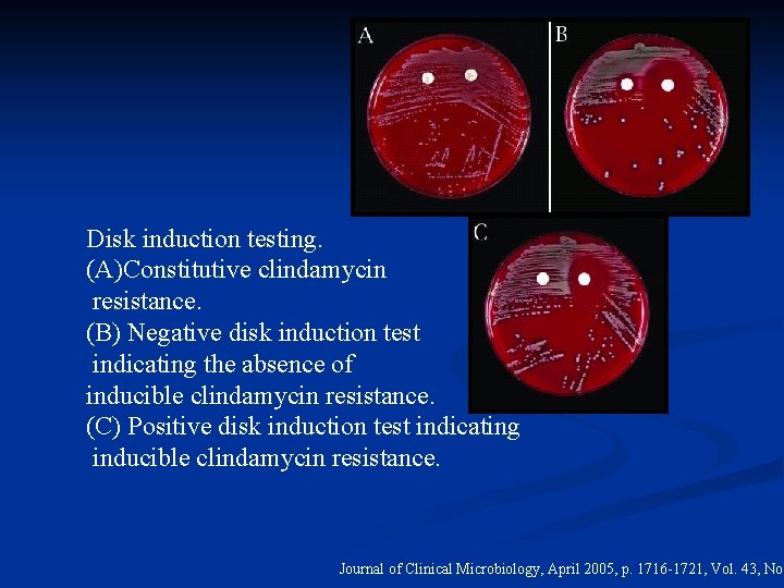 Disk induction testing. (A)Constitutive clindamycin resistance. (B) Negative disk induction test indicating the absence